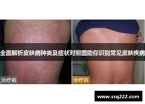 全面解析皮肤病种类及症状对照图助你识别常见皮肤疾病