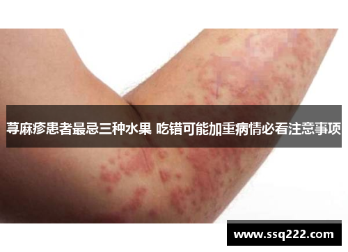 荨麻疹患者最忌三种水果 吃错可能加重病情必看注意事项
